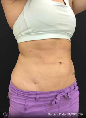 Liposuction