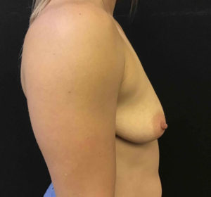 Breast Augmentation