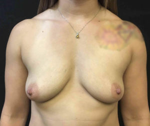 Breast Augmentation