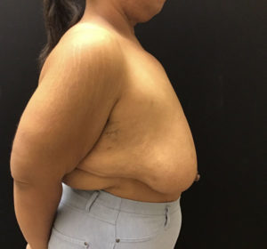 Breast Reduction