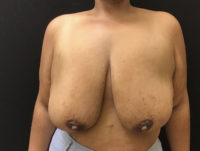 Breast Reduction