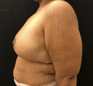 Breast Reduction
