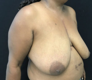 Breast Reduction