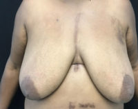Breast Reduction