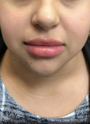 Lip Augmentation