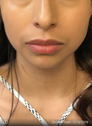 Lip Augmentation