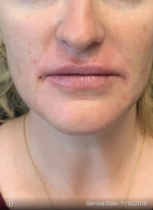 Lip Augmentation