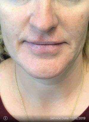 Lip Augmentation