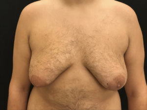 Gynecomastia