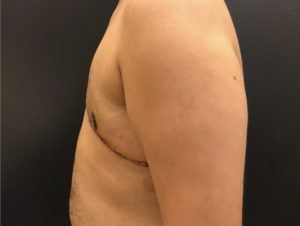 Gynecomastia