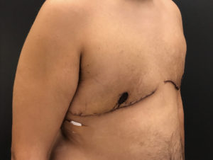 Gynecomastia