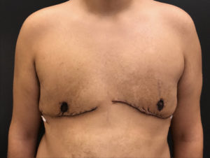 Gynecomastia