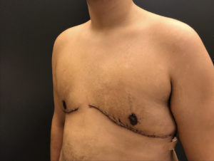 Gynecomastia