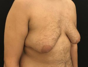 Gynecomastia