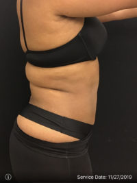 Liposuction
