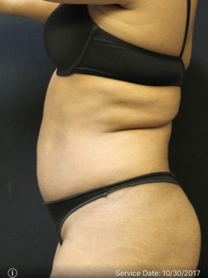 Liposuction