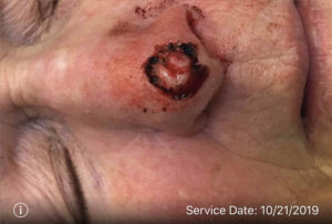 Basal Cell Carcinoma