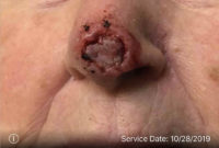 Basal Cell Carcinoma