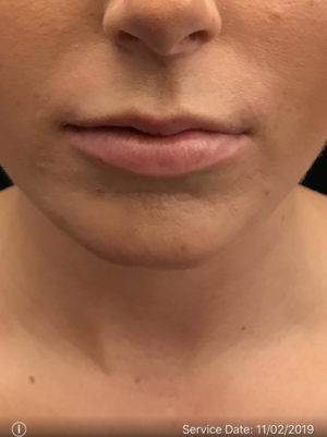 Lip Augmentation