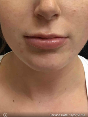 Lip Augmentation