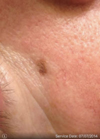 Malignant Melanoma