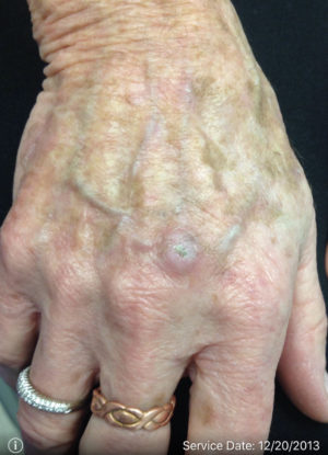 Squamous Cell Carcinoma