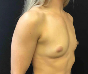 Breast Augmentation