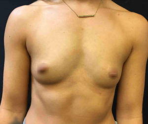 Breast Augmentation