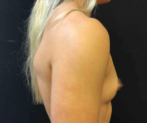 Breast Augmentation