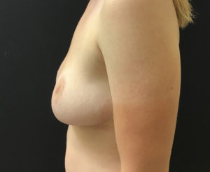 Breast Reduction
