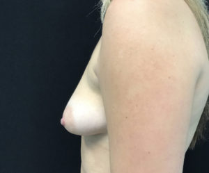 Breast Augmentation