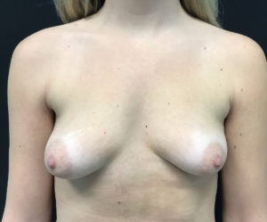 Breast Augmentation