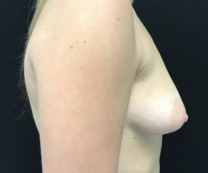 Breast Augmentation