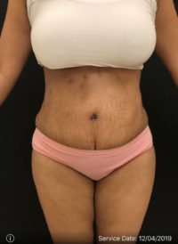 Tummy Tuck