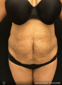 Tummy Tuck