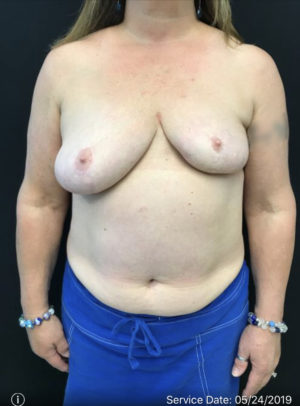 Breast Reconstruction