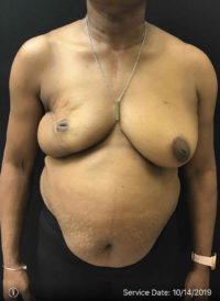 Breast Reconstruction