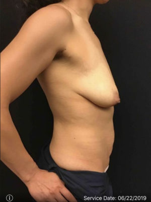 Breast Lift