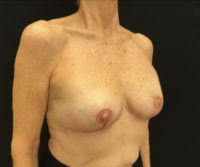 Breast Reduction