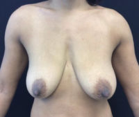 Breast Lift