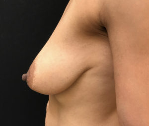 Breast Lift