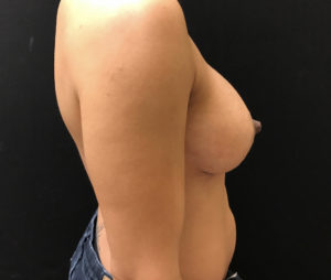 Breast Lift