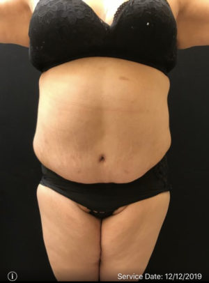 Tummy Tuck