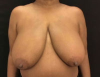 Breast Reduction