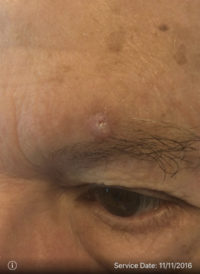 Basal Cell Carcinoma