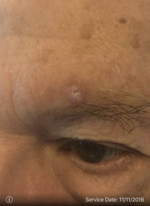 Basal Cell Carcinoma