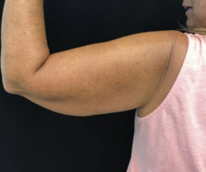Arm Lift