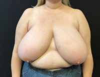 Breast Reduction