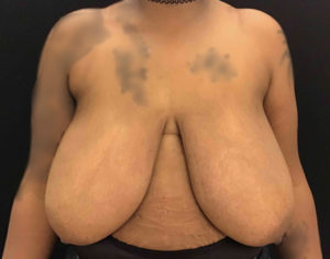 Breast Reduction