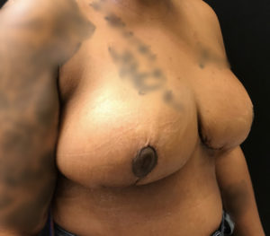 Breast Reduction